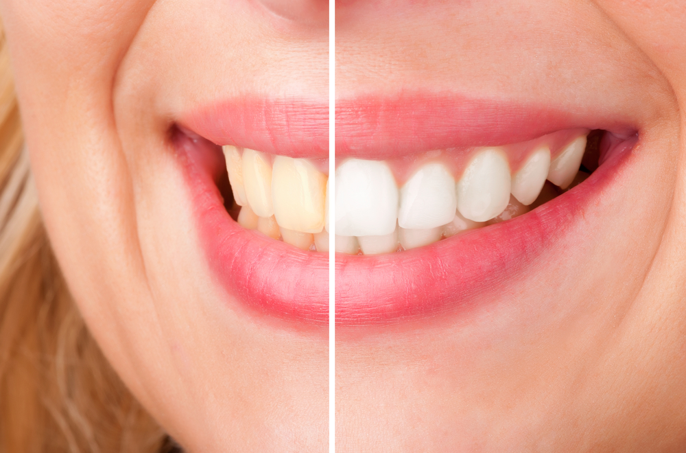 The Latest Teeth Whitening Technology